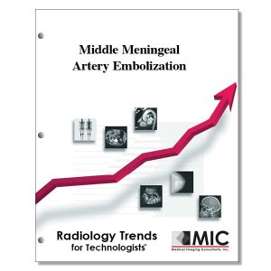 Middle Meningeal Artery Embolization